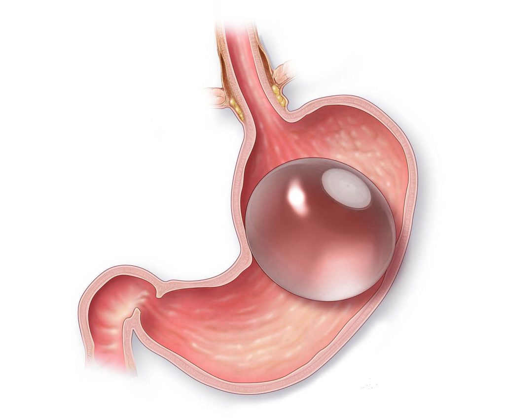 gastric balloon